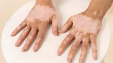 Vitiligo Hastalığı